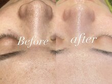 レシェルサロン(Lechelle Salon)/ハーブピーリング＋ダーマエステ