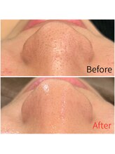 モアビューティー 紙屋町店/【毛穴吸引級でごっそり！】