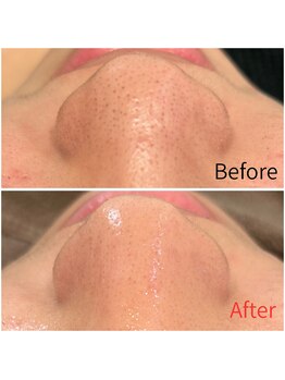 モアビューティー 紙屋町店/【毛穴吸引級でごっそり!】