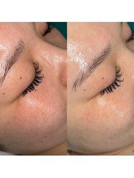 ヴィヴ 熊本(ViV)/セルマンフェイシャル初回