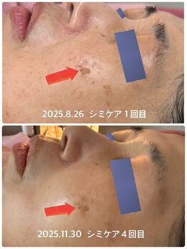 リエル(Liel)/低周波シミケア 蓄積シミも◎