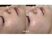 フロラスキン 銀座Miel店(florasKIN)/肌質改善プログラム