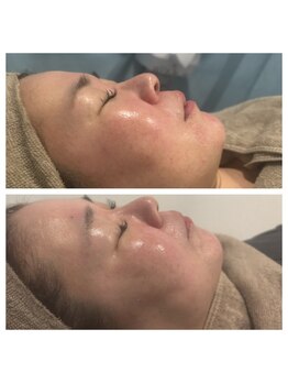 じぶんniプラス/常滑/フェイシャル/シミ/たるみ