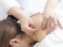 エルカミーノ鍼灸院の雰囲気(首・肩こりにお悩みの方◎全身鍼灸)