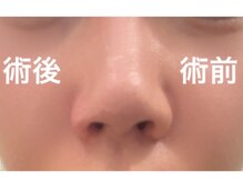 ブリリオ 池袋店(Brillio)/小鼻縮小/一回での施術
