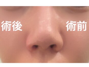 ブリリオ 池袋店(Brillio)/小鼻縮小/一回での施術