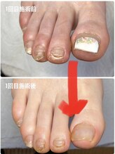 ラリベルテ(La liberte)/～巻き爪補正～