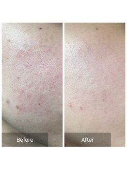 ディーキャットリー(D Catrry)/ハーブピーリング