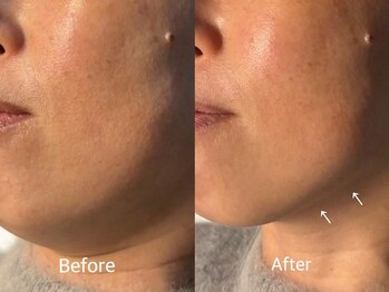 ラローズ(La Rose)/韓国シワたるみケア★サーマガン