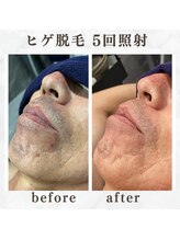 ボゴス(BOGOSS)/ヒゲ脱毛５回照射