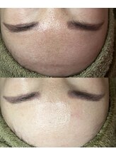 アディ(Adiy)/ビフォーアフター