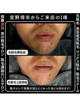ディースタイル 北谷店(Dstyle)/北谷メンズ脱毛ヒゲBefore after