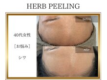 ロージー(ROSY)/ハーブピーリング/阿南/徳島