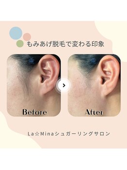 ラミーナ 新宿店(La☆Mina)/もみあげ等パーツ脱毛も可能