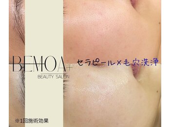 ビモアプラス(BEMOA+)/