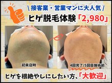 毛抜き屋 可児店/ヒゲ脱毛「全顔体験」2,980♪