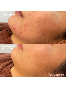 ワンブルーム(OneBloom)/肌荒れ改善には水素をプラス◎