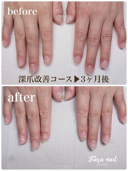 ティアラネイル 宇都宮/リプロネイル深爪矯正コース