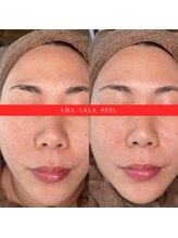 サンク(cinq)/大人気！！アイドルピーリング♪