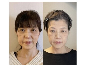 小顔22 ボルティ 本店(Bolty)/50代:小顔シンメトリー(4回)