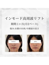 メディカルエステ 恵比寿店/＊インモードお顔 症例＊