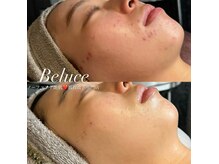 ベルーチェ(Beluce)の雰囲気（ニキビ、毛穴、凸凹◎ ハーブピーリングでノーファンデ肌）