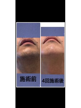 エクシア(excia)/メンズヒゲ脱毛