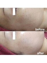 アイリアン(AiLien)/毛穴の開きやクスミ改善艶肌作り