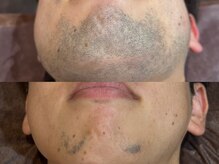 メンズ脱毛サロン ボス(BOSS)/＃ヒゲ脱毛【メンズ脱毛BOSS】