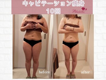 ブランリス(Blanclis)/痩身☆ビフォーアフター