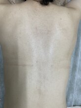 ナノハナ/鹿沼市の全身脱毛のナノハナ