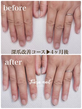 ティアラネイル 宇都宮/リプロネイル深爪矯正コース