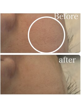 パールムーン(pearl moon)/水光肌フェイシャル/マーメイド