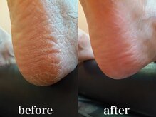 ドクターネイル爪革命 札幌本店/症例紹介２９　角質ケア