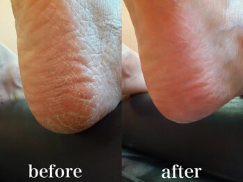 ドクターネイル爪革命 札幌本店/症例紹介29 角質ケア
