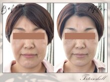 トーティシェル(tortoise shell)/糸リフト超えの変化