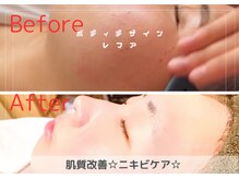 レフア/ハーブピーリング/ニキビ◎