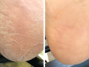 プラスホワイト 久我山の写真/《初めての方にも◎》乾燥や角質の蓄積によるガサつき・白くなったかかとを状況に合わせて丁寧にケア★