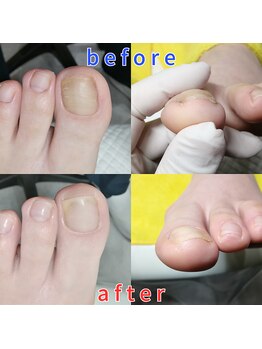 【肥厚・変形爪】ネイル/フット