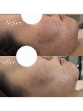 エースビューティー(Ace.Beauty)/長年の悩みも解決！