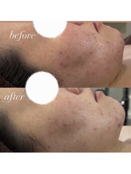 エースビューティー(Ace.Beauty)/長年の悩みも解決！