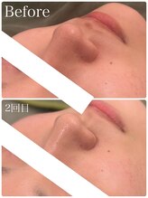 クラン 森ノ宮店(Clan)/20代女性・ハーブピーリング