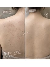 スキニティ 池袋(sknity)&nbsp;4回でこの 仕上がり
