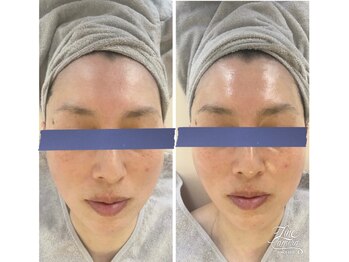 リッチベル(richbelle)/マイクロニードルモニター様