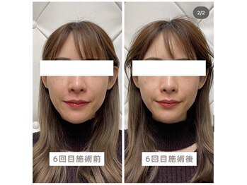 ヴィーライン 恵比寿本院(VeLine)/お客様Before After/小顔効果
