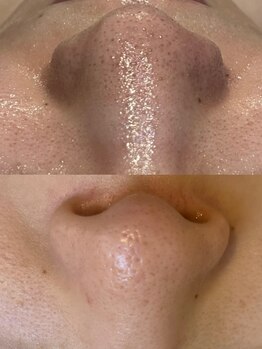 リングケー(Ling K)/苺鼻毛穴ケア