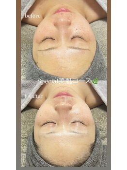 クレヴィー(Creviy)/Special美肌コース