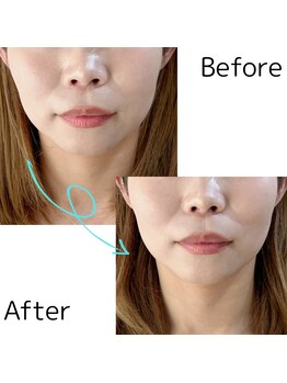 アンシュシュ(UNCHOUCHOU)/光フェイシャル「クイックケア」