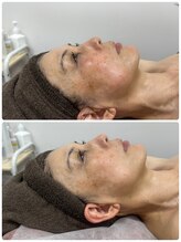 アルカンジュ(Archange)/コリをほぐしてリフトアップ♪