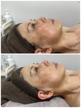 アルカンジュ(Archange)/コリをほぐしてリフトアップ♪